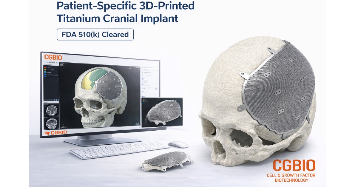 CGBIO Wins FDA Nod for Easymade TI Patient-Specific Cranial Implant